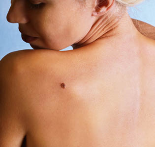 Mélanome : cancer de la peau